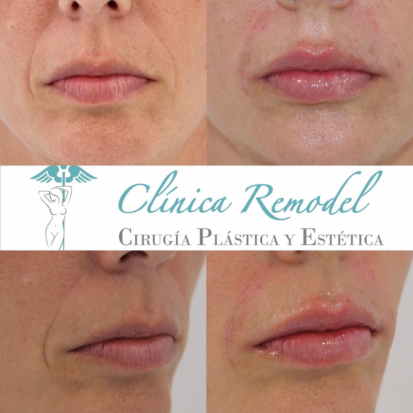 aumento de labios en las palmas