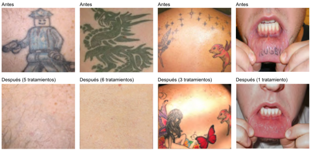 eliminar tatuajes las palmas